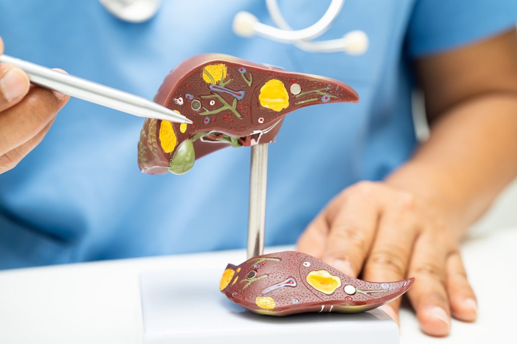 niealkoholowe stłuszczenie wątroby